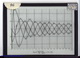 Slide: Partial derivative of the Bessel function